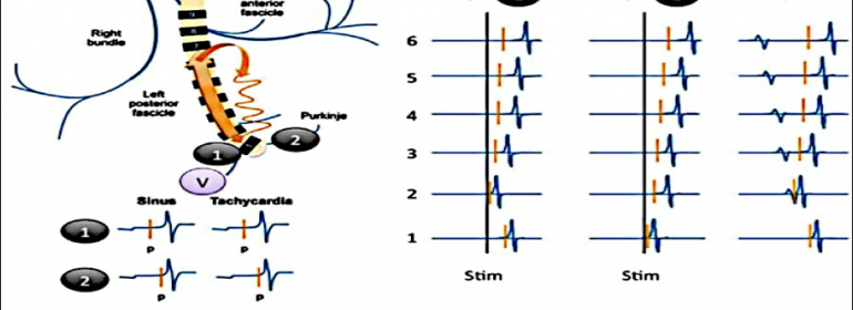 Taquicardias fasciculares: desde la anatomía fascicular hasta la ablación por radiofrecuencia de las taquicardias