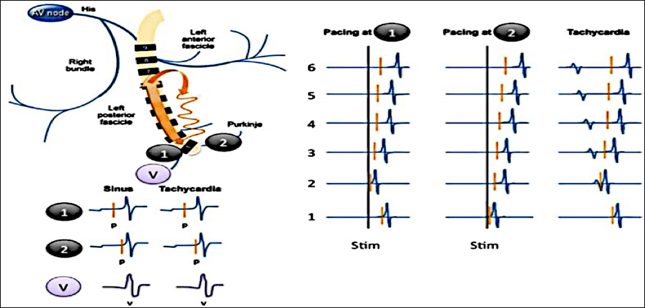 Taquicardias fasciculares: desde la anatomía fascicular hasta la ablación por radiofrecuencia de las taquicardias