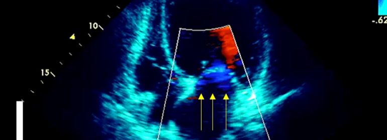 Terapia de resincronización cardíaca en presencia de bloqueo de rama derecha o trastornos inespecíficos de la conducción intraventricular