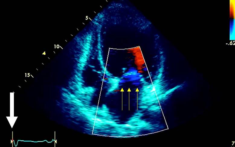 Terapia de resincronización cardíaca en presencia de bloqueo de rama derecha o trastornos inespecíficos de la conducción intraventricular