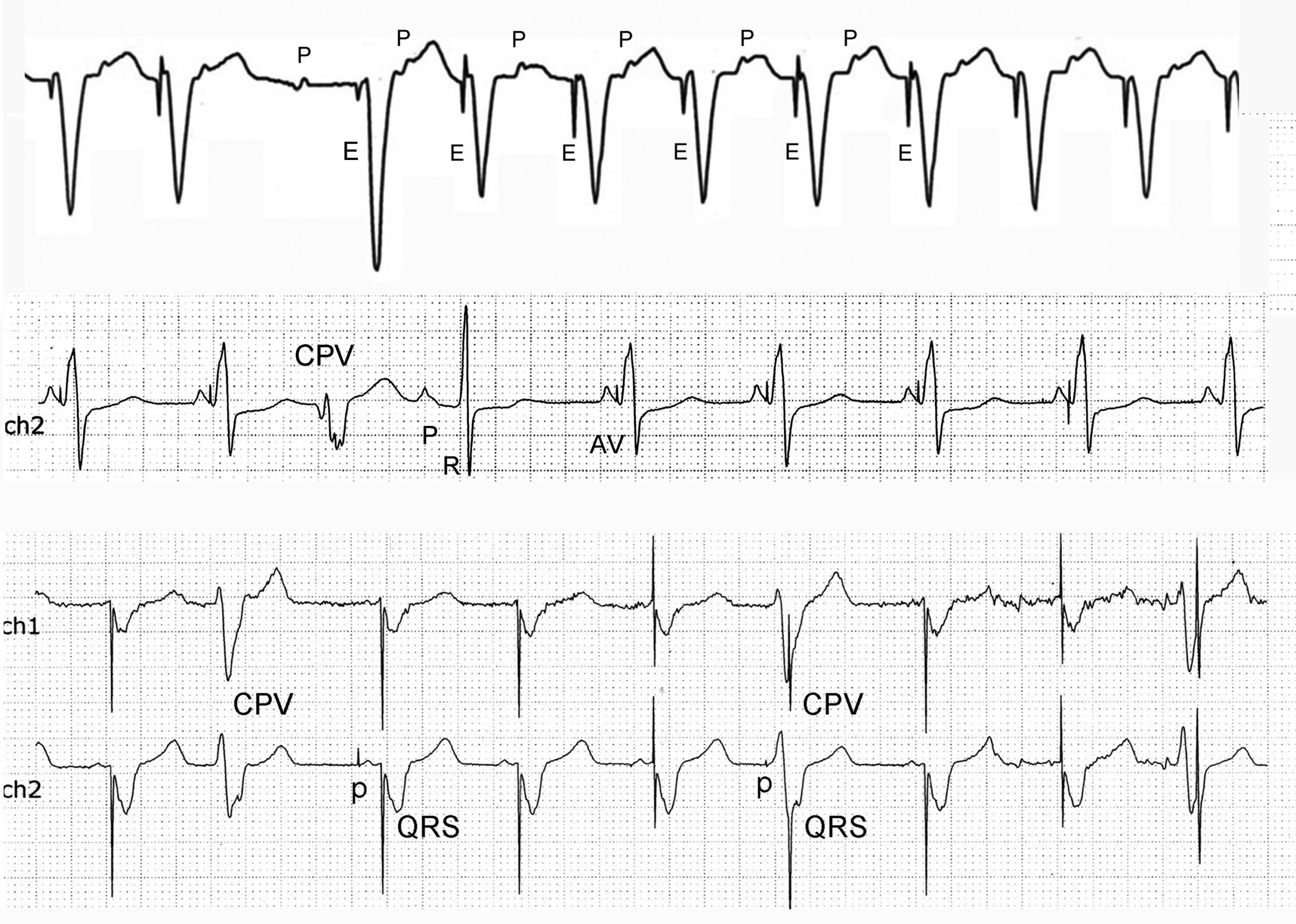 Eventos electrocardiográficos que semejan disfunción de marcapasos