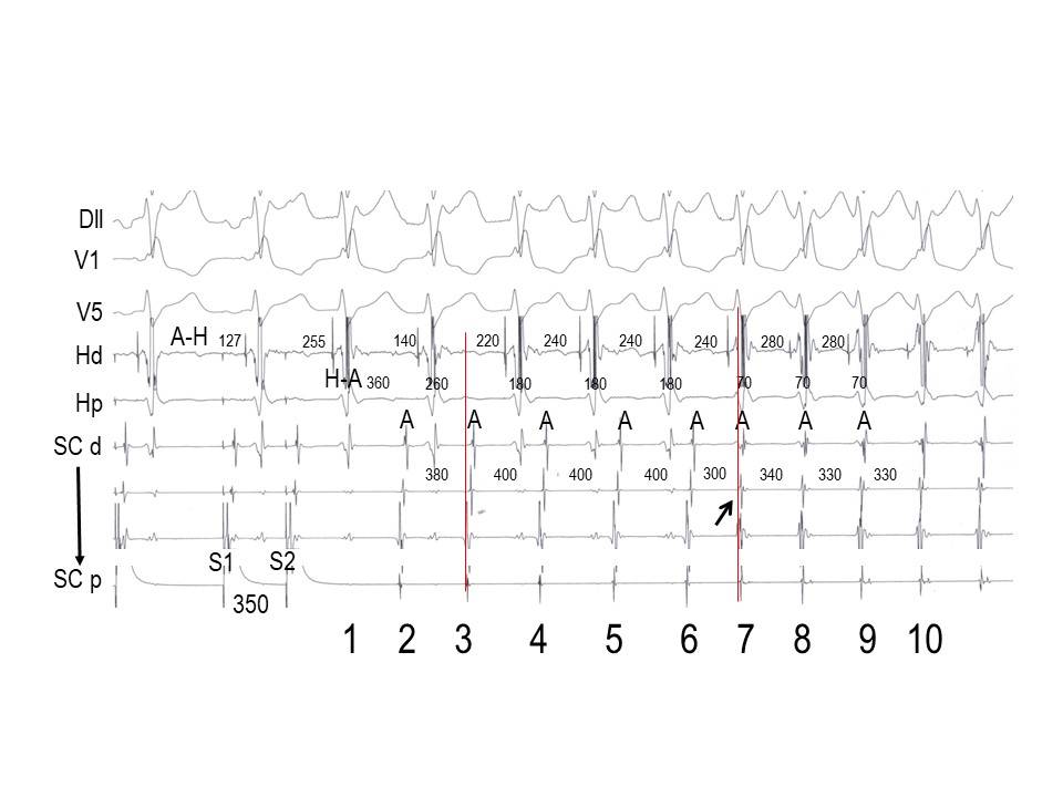 Participación de múltiples vías aurículo-ventriculares en una taquicardia por reentrada nodal