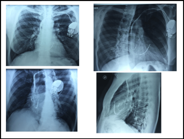 Estimulación parahisiana con cardiodesfibrilador implantable para el tratamiento de pacientes con Síndrome de Brugada