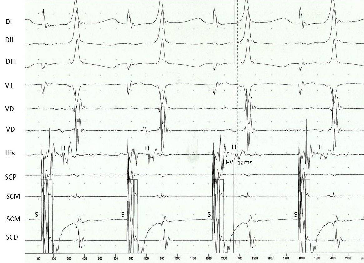 Vías anómalas fasciculoventriculares. Características clínicas y electrofisiológicas de una rara variante de preexcitación