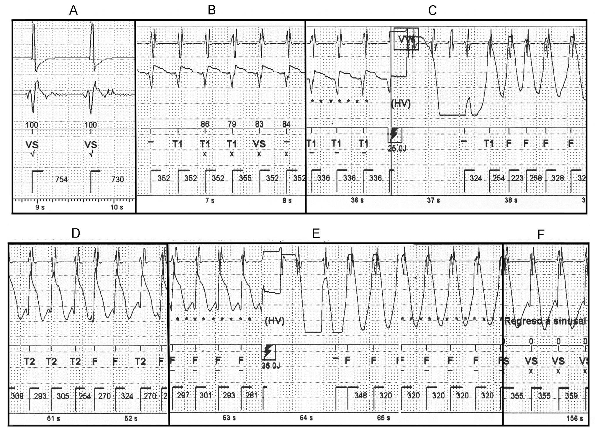 Choques inapropiados y proarritmia en un cardiodesfibrilador implantable