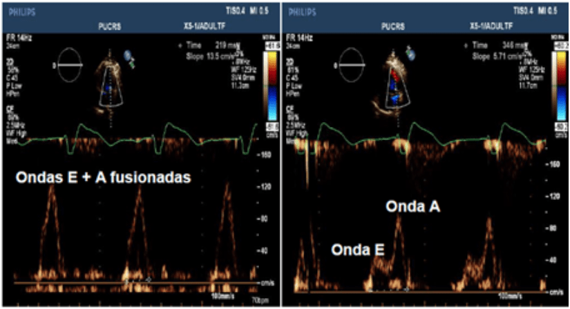 Disincronía AV en pacientes con marcapaso definitivo por enfermedad binodal (disfunción del nodo sinusal y bloqueo AV de 1 grado). ¿El PR largo sintomático paga el precio de evitar el QRS estimulado?