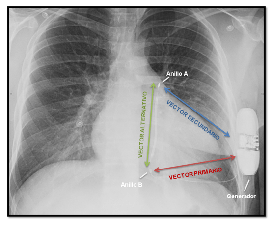 Cardiodesfibrilador implantable subcutáneo: revisión bibliográfica y experiencia en un centro español