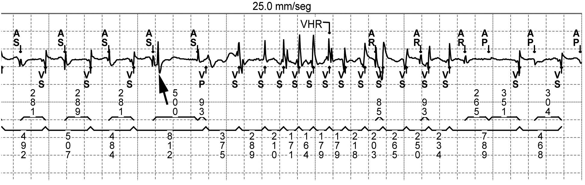 Taquicardia ventricular polimorfa inducida por marcapasos