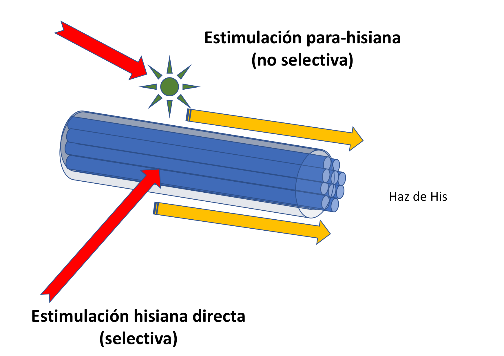 Técnica de implante para-hisiano guiado por sincronía eléctrica