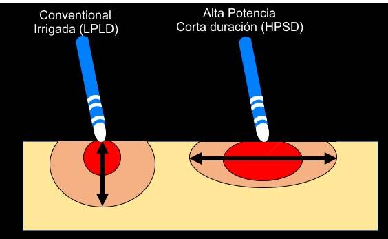 Aislamiento de venas pulmonares mediante aplicaciones de radiofrecuencia de alta potencia y baja duración: ¿Una moda peligrosa o un modo que viene para quedarse?