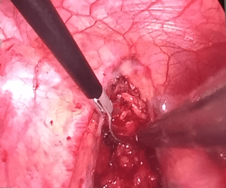 Denervación simpática bilateral en paciente con taquicardia ventricular polimorfa catecolaminérgica y tormenta eléctrica