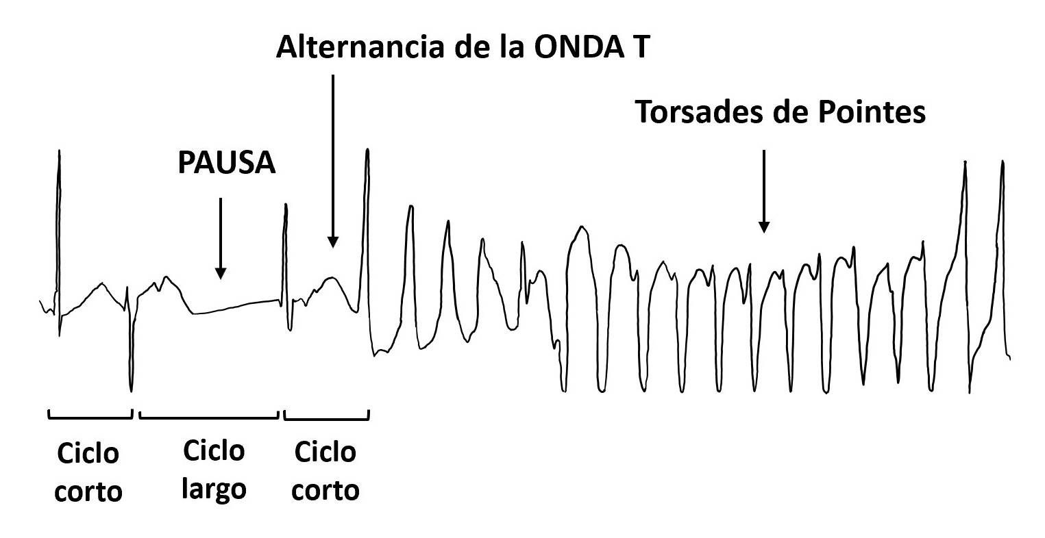 Taquicardias ventriculares polimórficas en el escenario de la pandemia por COVID-19. Hidroxicloroquina, Azitromicina y prolongación de QTc