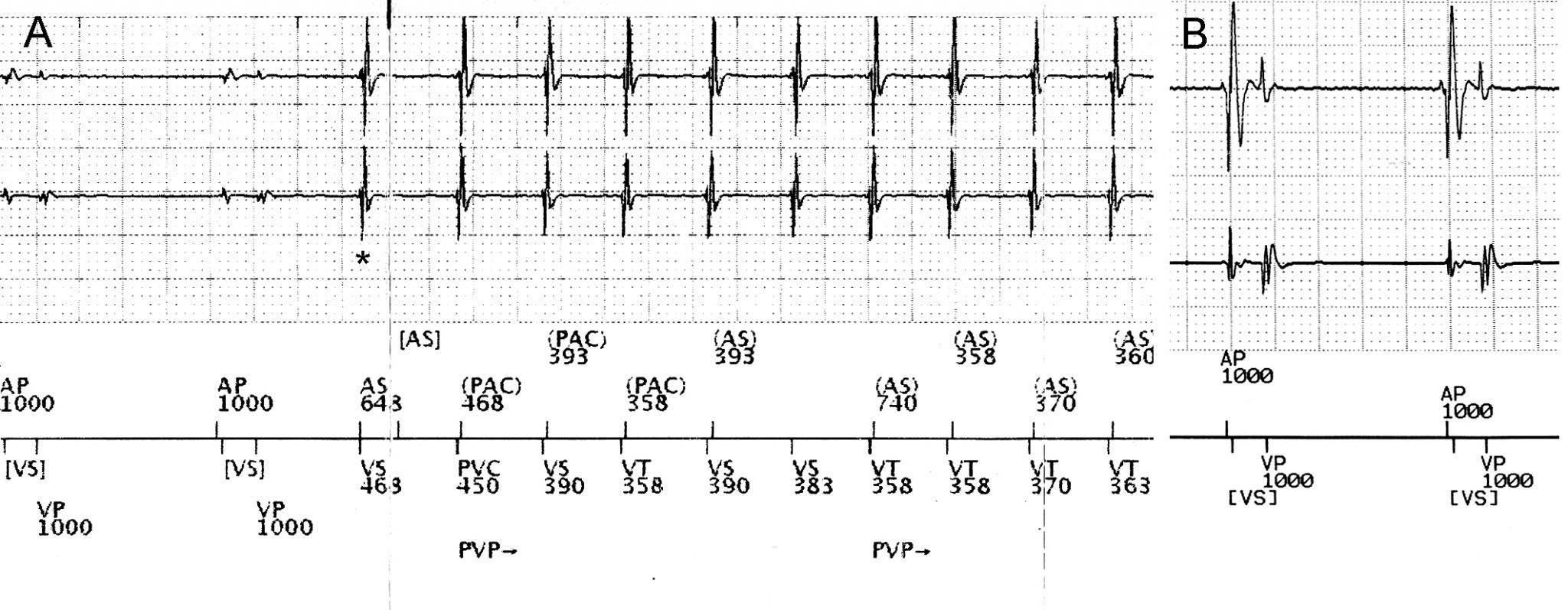 Guía para la interpretación de los electrogramas almacenados en los dispositivos cardíacos implantables