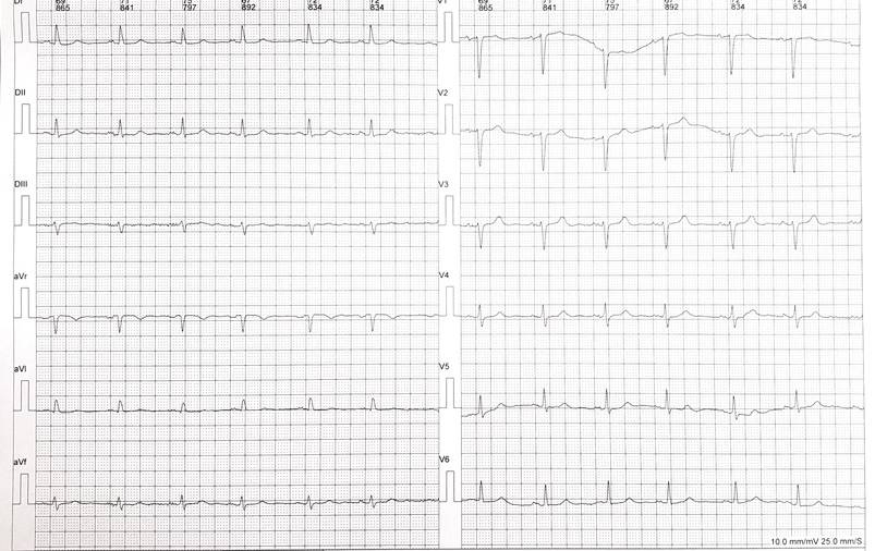 Taquicardia ventricular polimórfica desencadenada por extrasístole con intervalo de acoplamiento corto en paciente con corazón sano